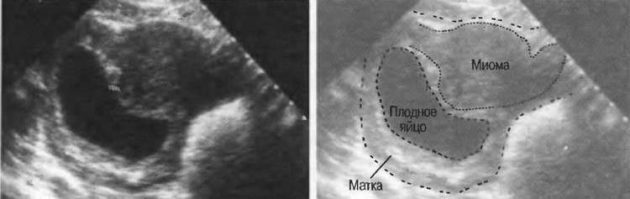 Fibromes utérins pendant la grossesse: aux premiers stades, au deuxième et au troisième trimestre, les conséquences