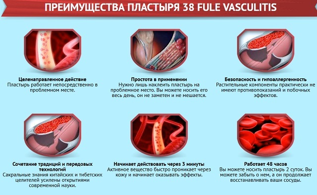 Kinesisk gips 38 Fule Vasculitis vil slippe af med åreknuder og vaskulitis