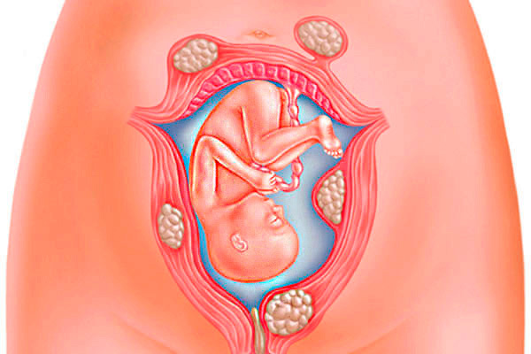 Ist es möglich, mit Uterusmyomen schwanger zu werden und zu gebären?