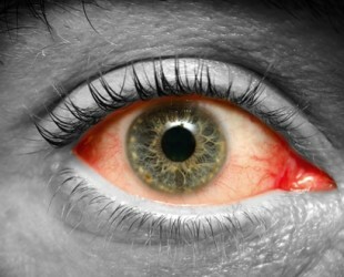 Ką reiškia akių paraudimas?
