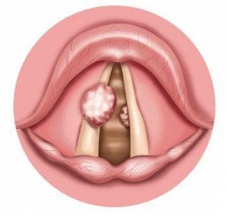 pólipos en la garganta