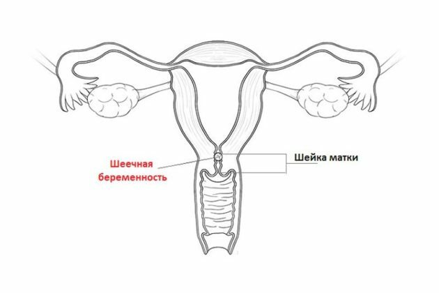 Grossesse cervicale: signes, diagnostic, code CIM-10, traitement, avis