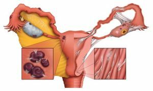 pathologisch proces in de testikels