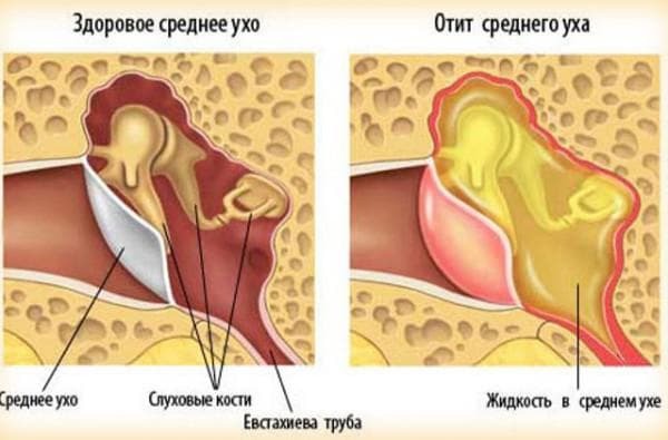 vnetje simptomov srednjega ušesa