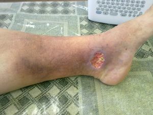 trophic ulcer on the shin