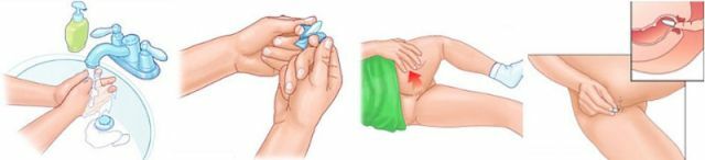 Rektálne čapíky Hemoprotekt: podrobné pokyny na použitie