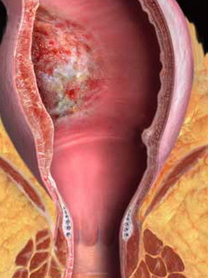 Úlcera perineal posparto: síntomas, diagnóstico, tratamiento