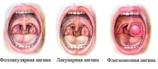 lacunar tonsillitis