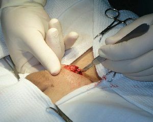 microchirurgische revascularisatie van de testikel
