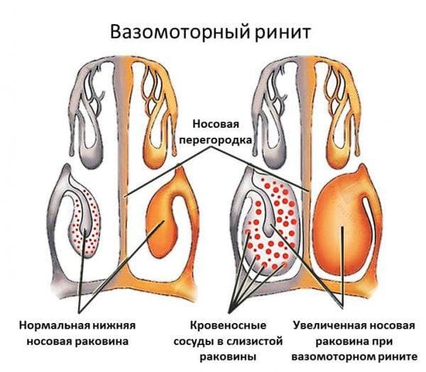 rinitis vasomotor