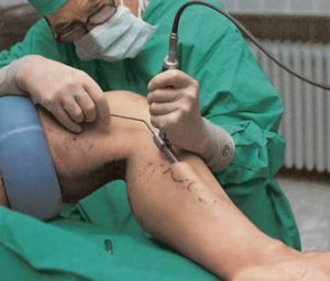 Striping with varicose veins is a mini-invasive method for treating a disease