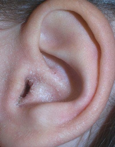 Simptomele și cauzele apariției ciupercii urechii la om