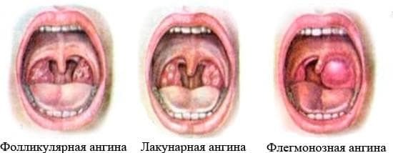 Qual a aparência da garganta na dor de garganta?
