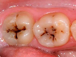 Un kyste sur une dent: qu'est-ce que c'est, symptômes, photos, traitement et conséquences