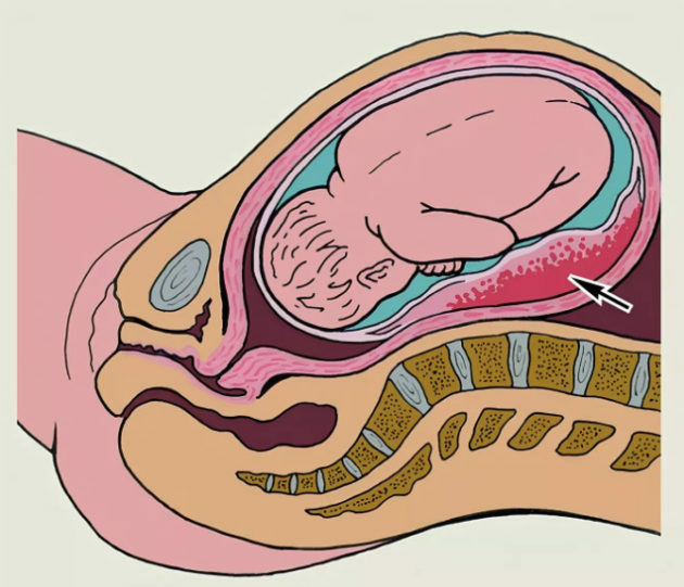 Décollement placentaire prématuré: causes, symptômes, traitement