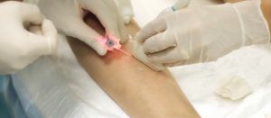 Wie effektiv ist die Behandlung von Krampfadern mit einem Laser?