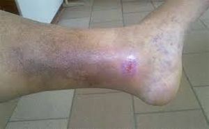 Tratamento complexo das úlceras tróficas da perna