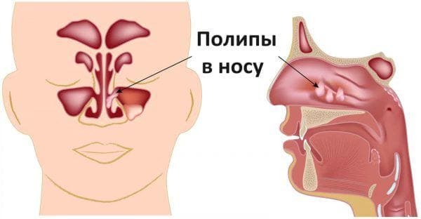 polyps i näsan