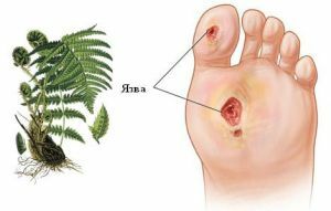 What determines the effectiveness of treatment of trophic ulcers with folk remedies: tips and proven recipes