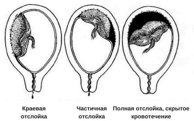 Décollement prématuré d'un placenta normalement localisé: types, signes caractéristiques, diagnostic, prévention, facteurs de risque