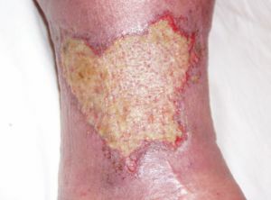 trophic ulcer on the leg
