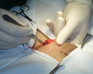 operacija