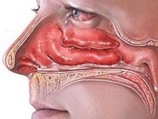 edema de la mucosa nasal