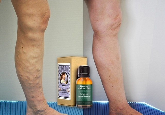 Wax Cream Healthy - effective treatment of varicose veins