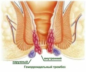Thrombose des ganglions