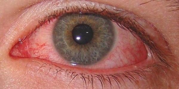 Crom-alerģija: cik noderīga ir zāles acīm?