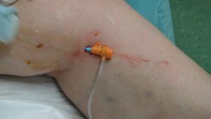 Radiofrequency obliteration - treatment of veins by means of waves