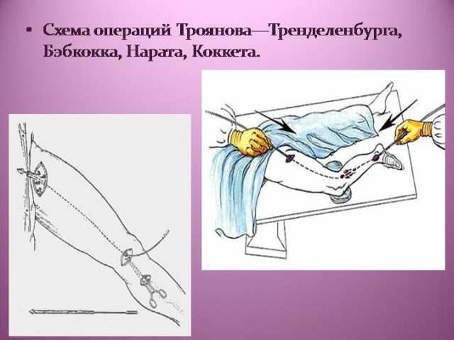 Operácia Trianelenburg Troyanov - chirurgická intervencia na subkutánnej žile