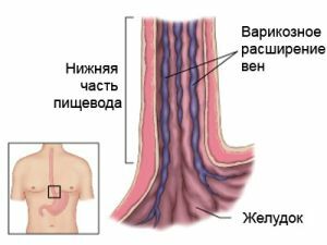 Kŕčové žily v pažeráku - klasifikácia a rozsah ochorenia, metódy liečby
