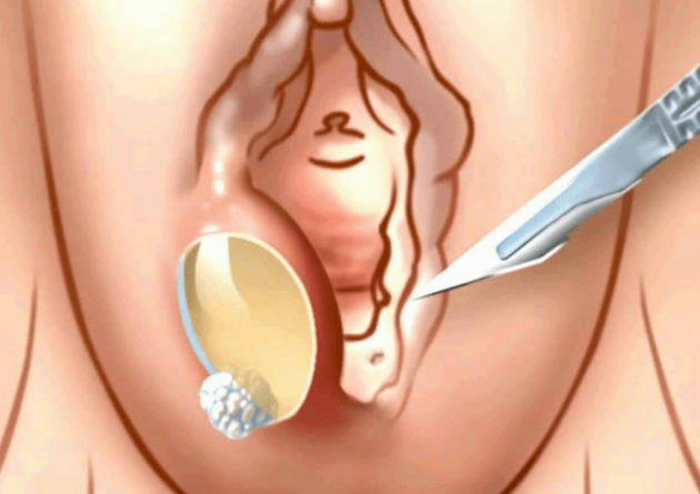 Ulkus perineum postpartum: gejala, diagnosis, pengobatan