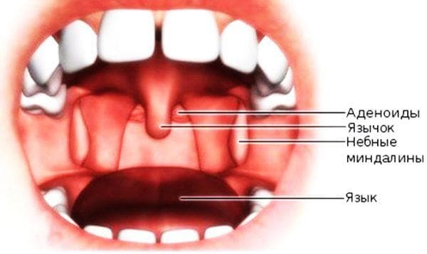 Les symptômes et le traitement des kystes sur l'amygdale
