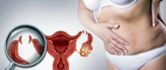 uterine Serozometra