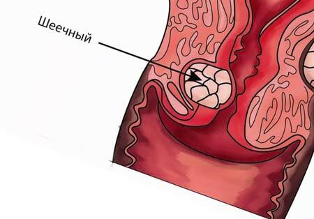 Grossesse cervicale: qu'est-ce que c'est, symptômes, directives cliniques