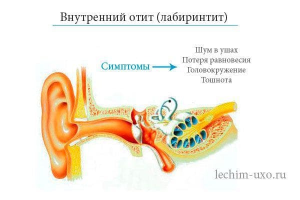 otitis notranjega ušesa