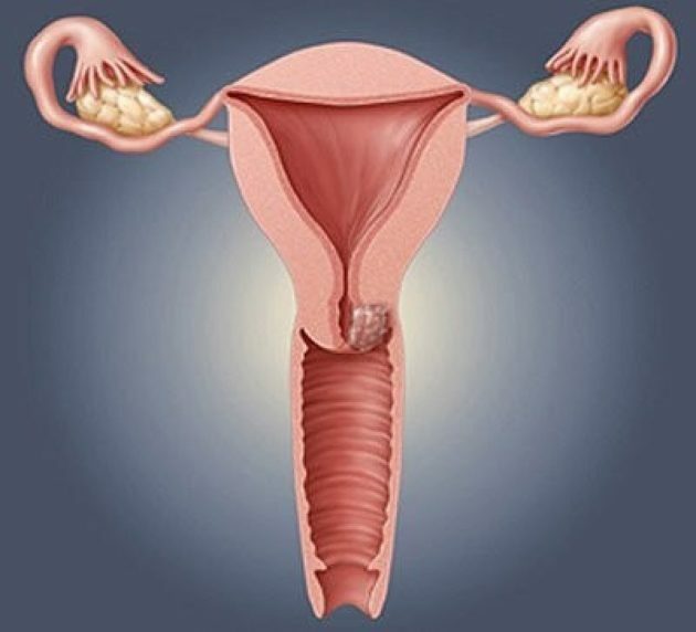 Kraurosis van de vulva: symptomen, oorzaken, behandeling, foto's, beoordelingen