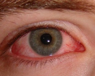 Gotas oculares Pilocarpina para o tratamento bem sucedido de glaucoma e outras doenças