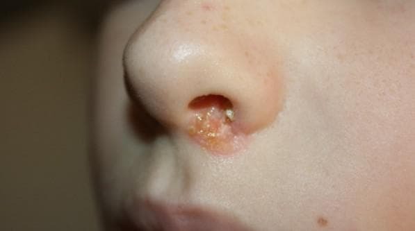 Cortex dans le nez cause et traitement