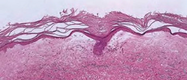 Kraurosis vulva: gejala, penyebab, pengobatan, foto, ulasan