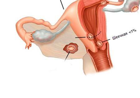 Cervikálne tehotenstvo: čo je, príznaky, klinické pokyny