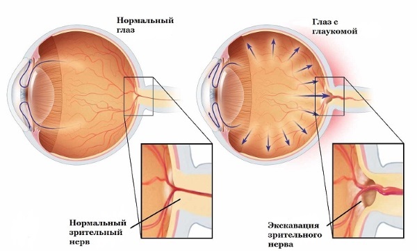 Okumed - pilieni no glaukomas