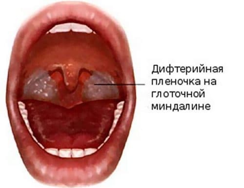 fibrozivno vneto grlo