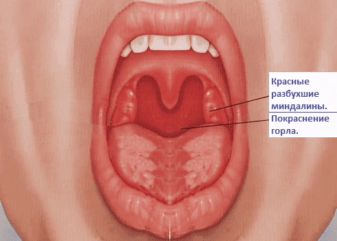 äge katarraalne tonsilliit
