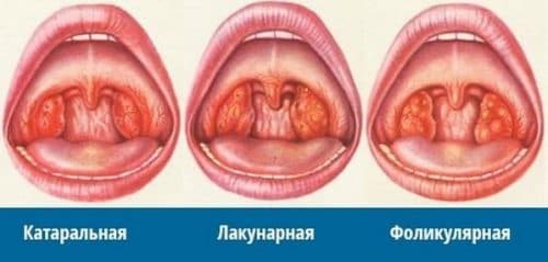 lacunar tonsillitis