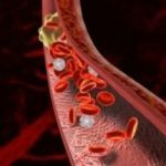 coágulo de sangre en las arterias