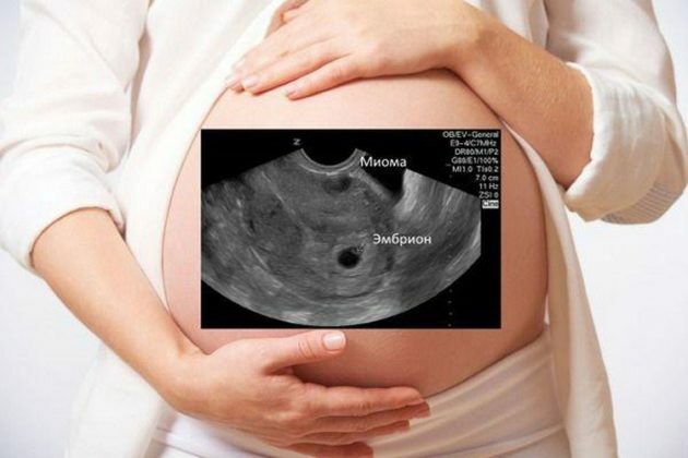 Mioma o embarazo: cómo distinguir