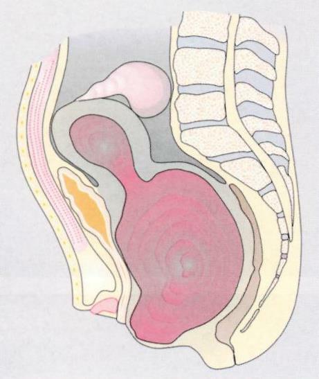 Atrésie vaginale: tiers inférieur, symptômes, traitement